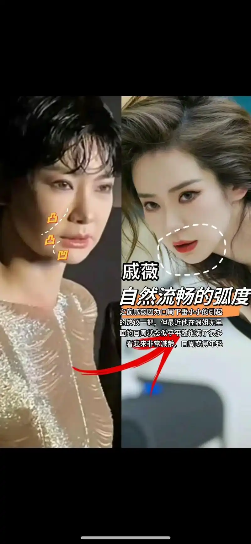 之前戚薇因为口周下垂小小的引起的热议一把, - 抖音