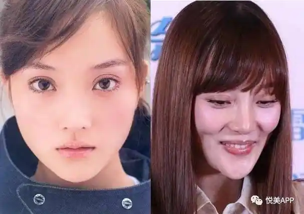 明星毁容大多因中了苹果肌的毒