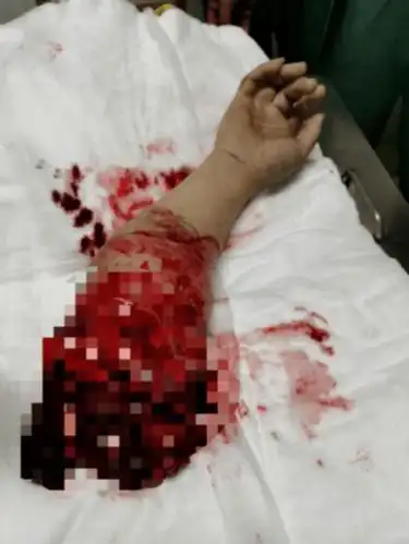 一声惨叫,手臂被机器离断,一晚奋战,断臂再植成功