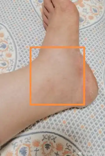 孕35w3d,今天下班到家发现左脚肿了   北京