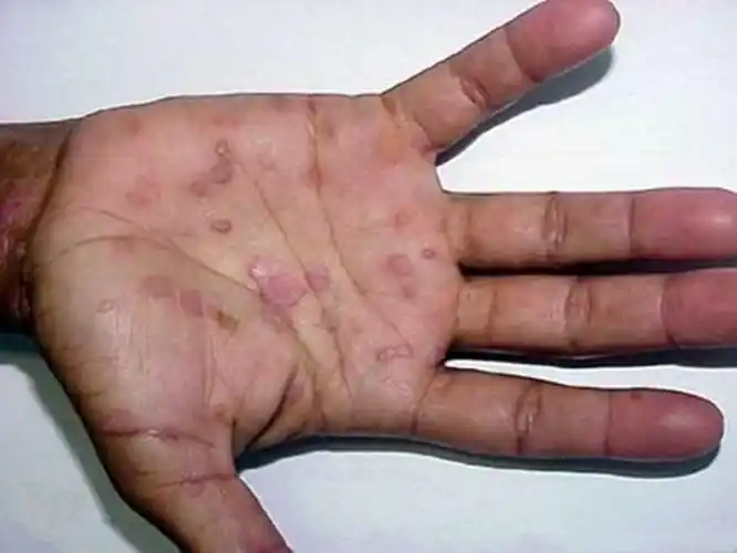 一期梅毒初期生殖器图片