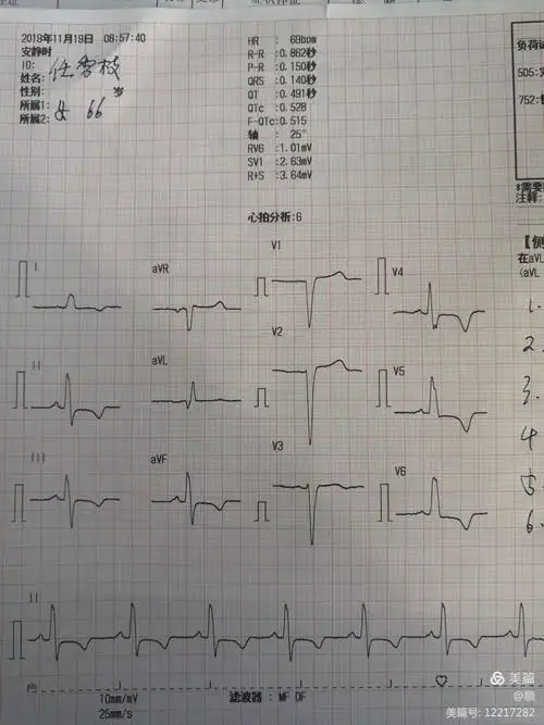 异常心电图图谱