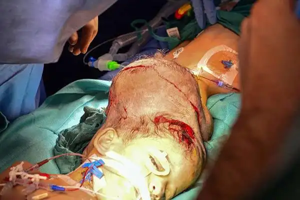 叙利亚头部连体女童历经十小时手术成功分离