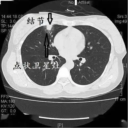十二个病人的肺ct图像详细解读!_结核