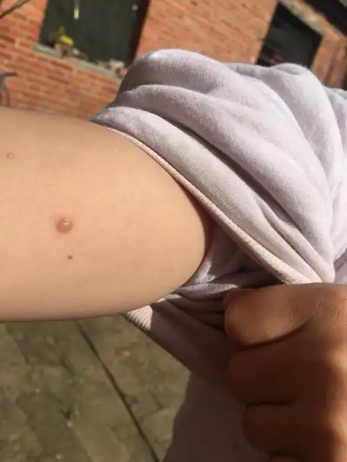 我女儿身上长了好多疣,开始一个,现在有好多了,有什么好的药可以擦吗?