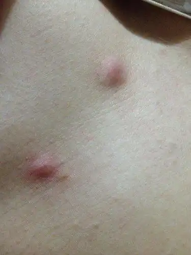 请各位二十来岁的美女帮忙回答你们是不是也有这种乳房小肉颗啊?