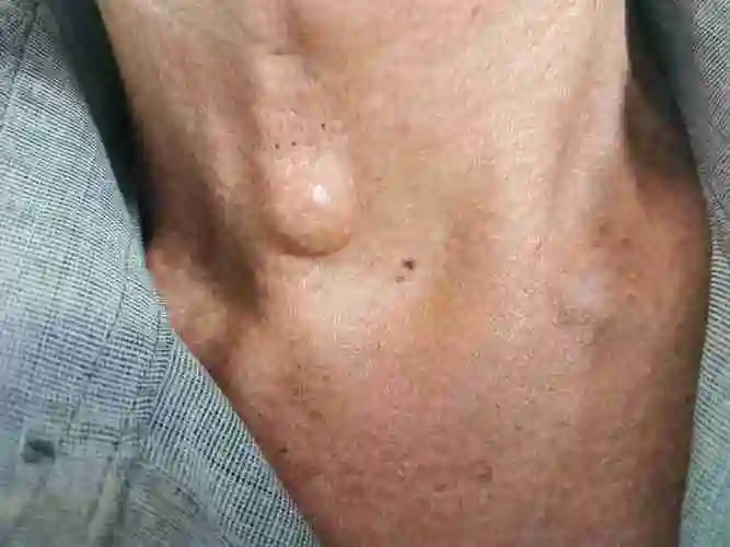 脖子外面长了一个硬硬的疙瘩,但是不痛