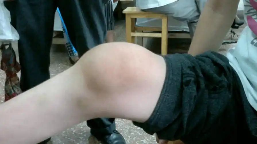 滑膜炎膝关节肿胀?就这4招,30天轻松消肿止痛!_膝盖_运动_基本