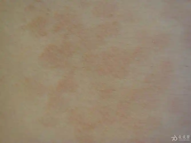 典型皮肤病之花斑癣(汗斑)