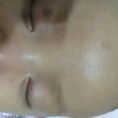 宝宝脸上的小颗粒是什么