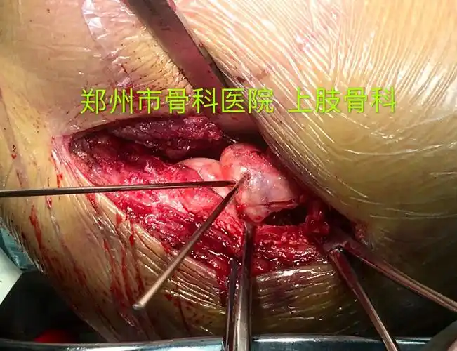 桡骨头复位后克氏针临时固定