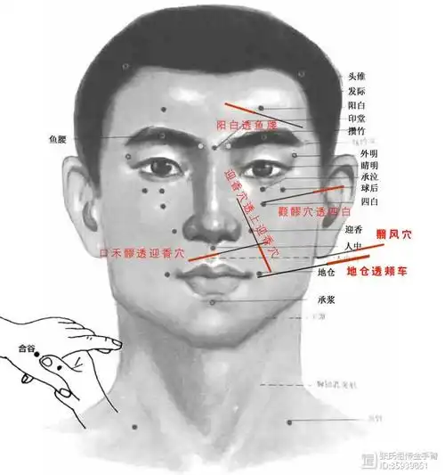 145期-面三针(面瘫针法调治总要)