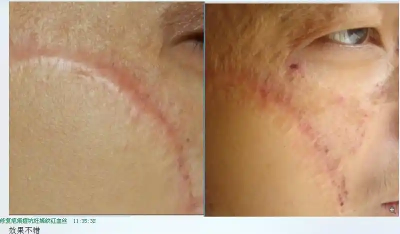 记录下:4岁到19岁的植皮疤痕,使用修巴堂修复6天变化.