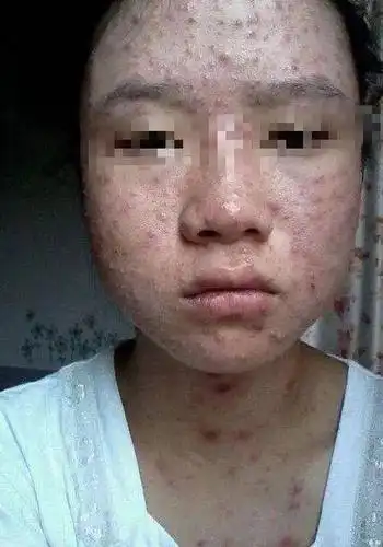 常见病毒感染性皮肤病科普一水痘