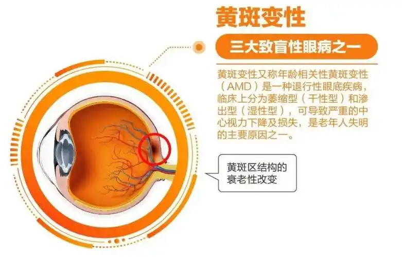 老眼昏花老人要提防视力隐形杀手黄斑变性