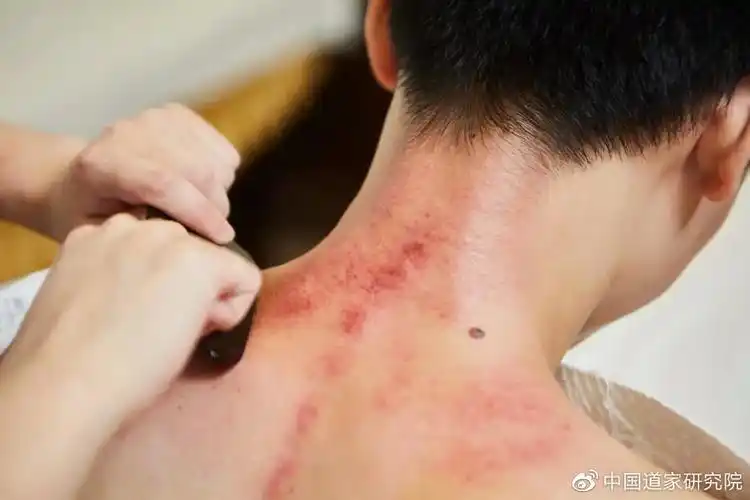 百治不如一刮10种刮痧法刮走全身疾病用勺子就能做