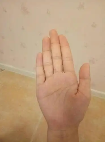 左手掌纹为断掌掌纹,右手接近于断掌,也类似于川字掌纹.