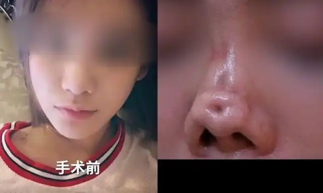 90后女主播整容失败,鼻梁塌陷还有坑画面吓人!哭诉被医院坑惨