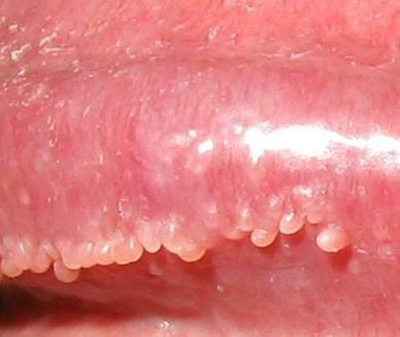 假尖锐湿疣白醋测试图片_有来医生