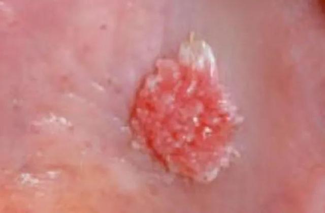 菜花状尖锐疣是高危病毒吗