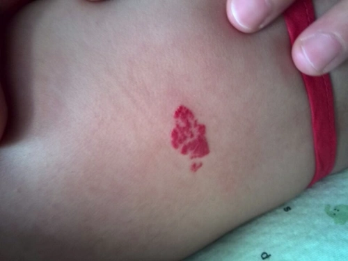 宝宝后背长个血管瘤,在上海激光三次了花了一万块了,这两天发现还有