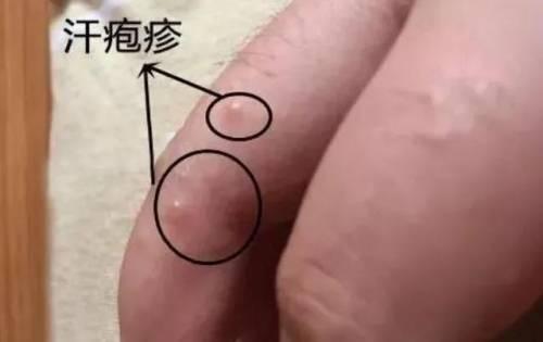 如何辨别湿疹和汗疱疹
