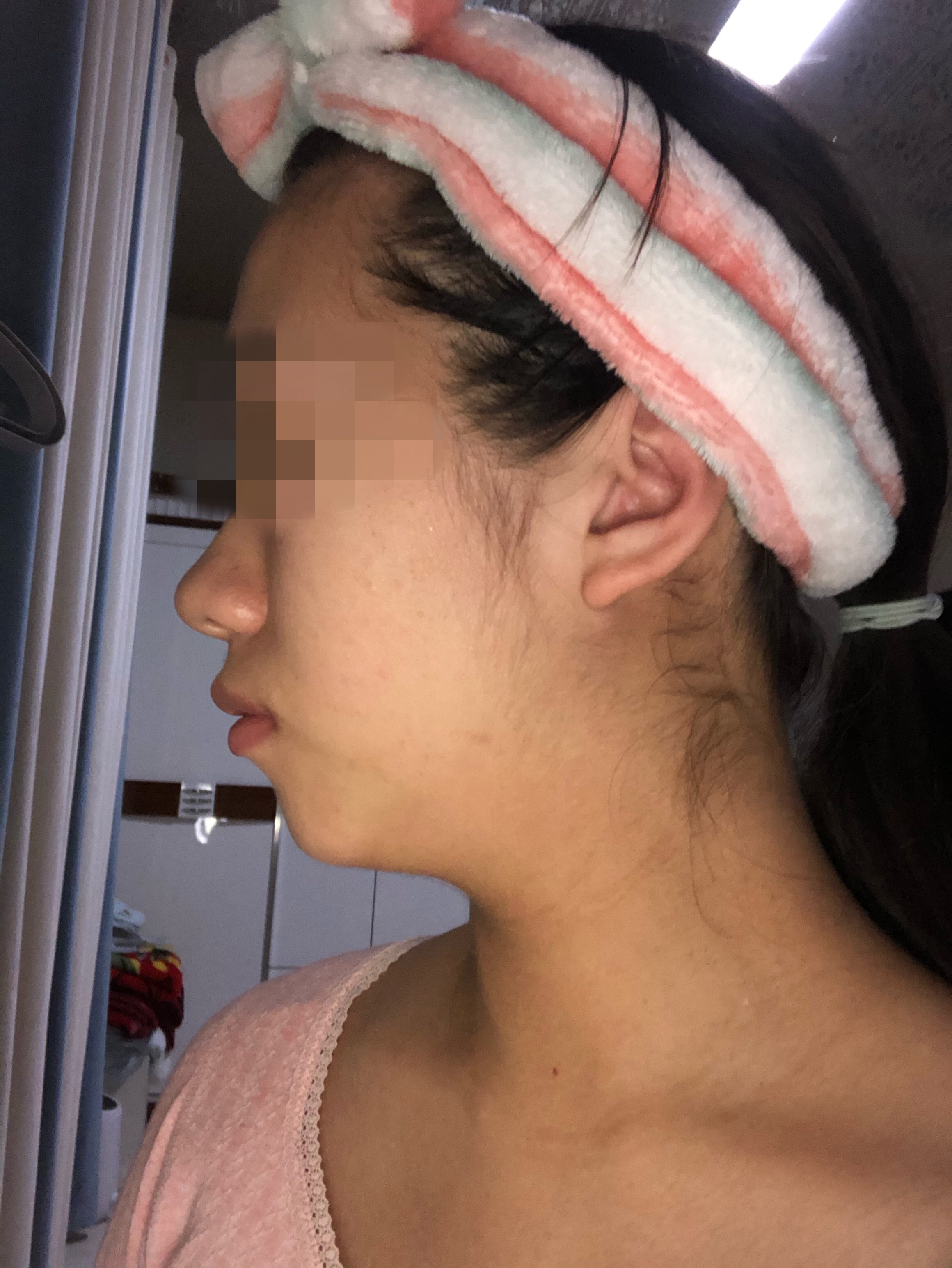 请问我这个是嘴凸还是下巴后缩啊矫正牙齿能起作用吗还是说得做反颌