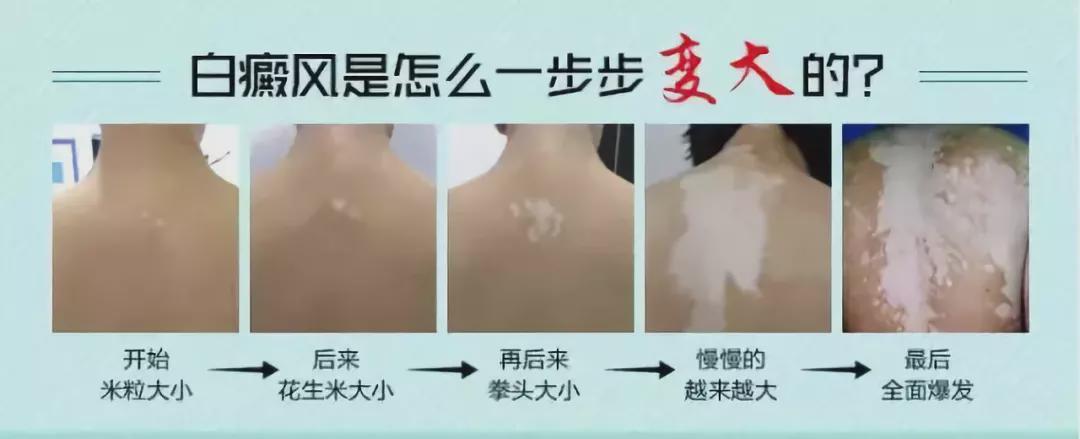 但是依然需要尽快到医院进行检查,因为可能是其他的疾病,如花斑癣