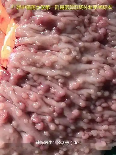 息肉是什么东西_息肉