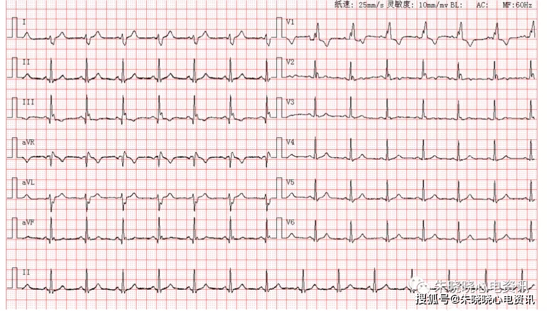 完全性右束支传导阻滞伴左后分支传导阻滞