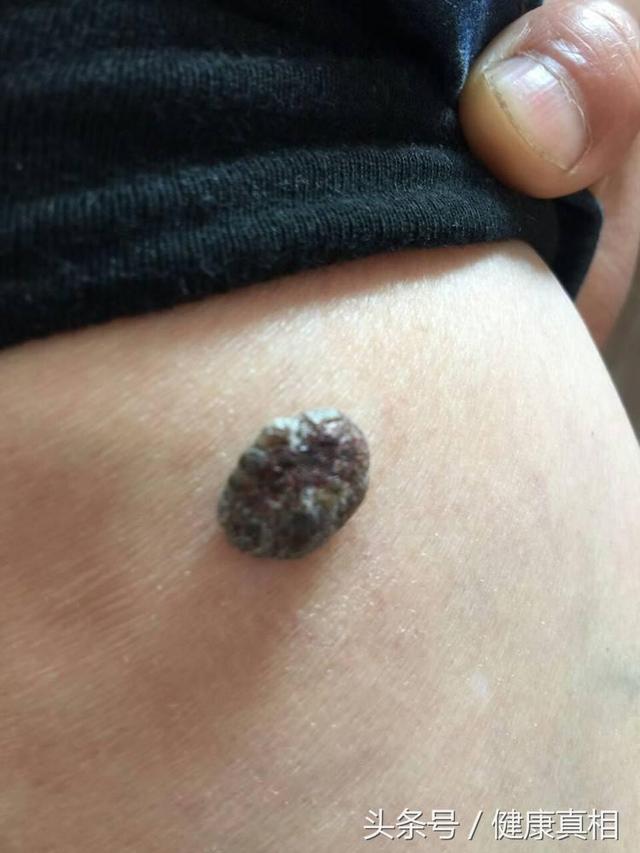 身上有个黑痣要小心很可能是癌症在作怪