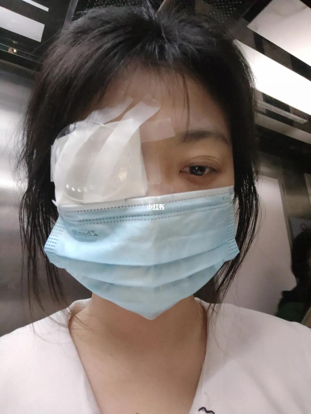 晶体植入手术第二天