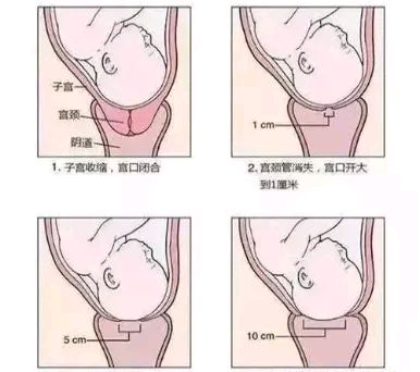 当分娩的信号来临,随着子宫的阵发性收缩,宫颈逐渐软化,缩短直至消失