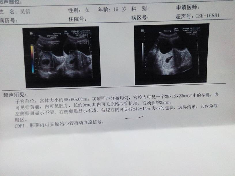 宝妈们,我怀孕45天做b超检查发现盆腔右侧可见47毫米大小包块怎么回事