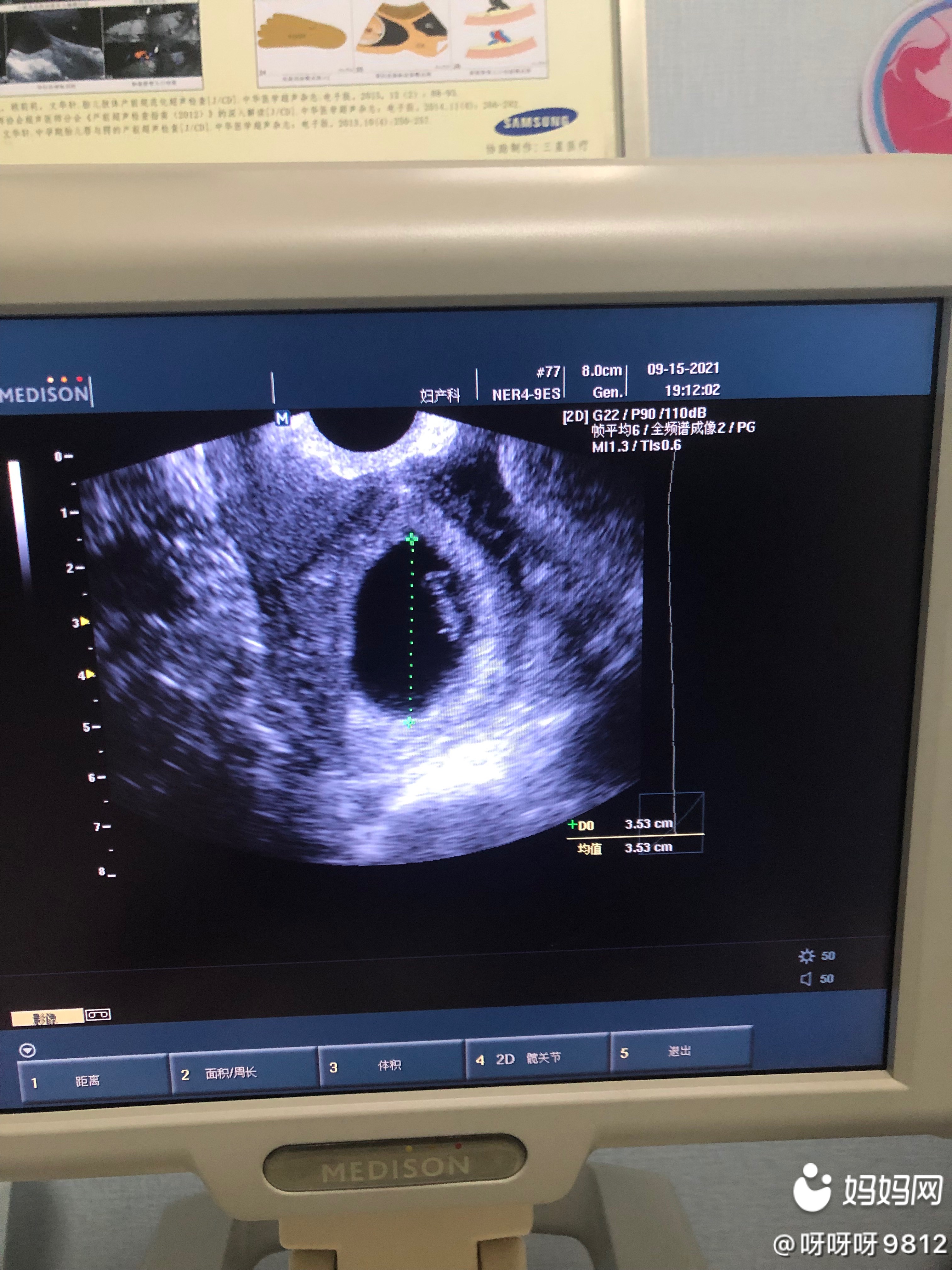 七周加一的宝宝,孕囊看男女准吗