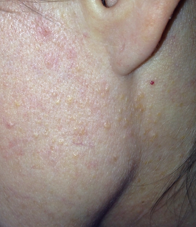 橘皮样皮肤图片45