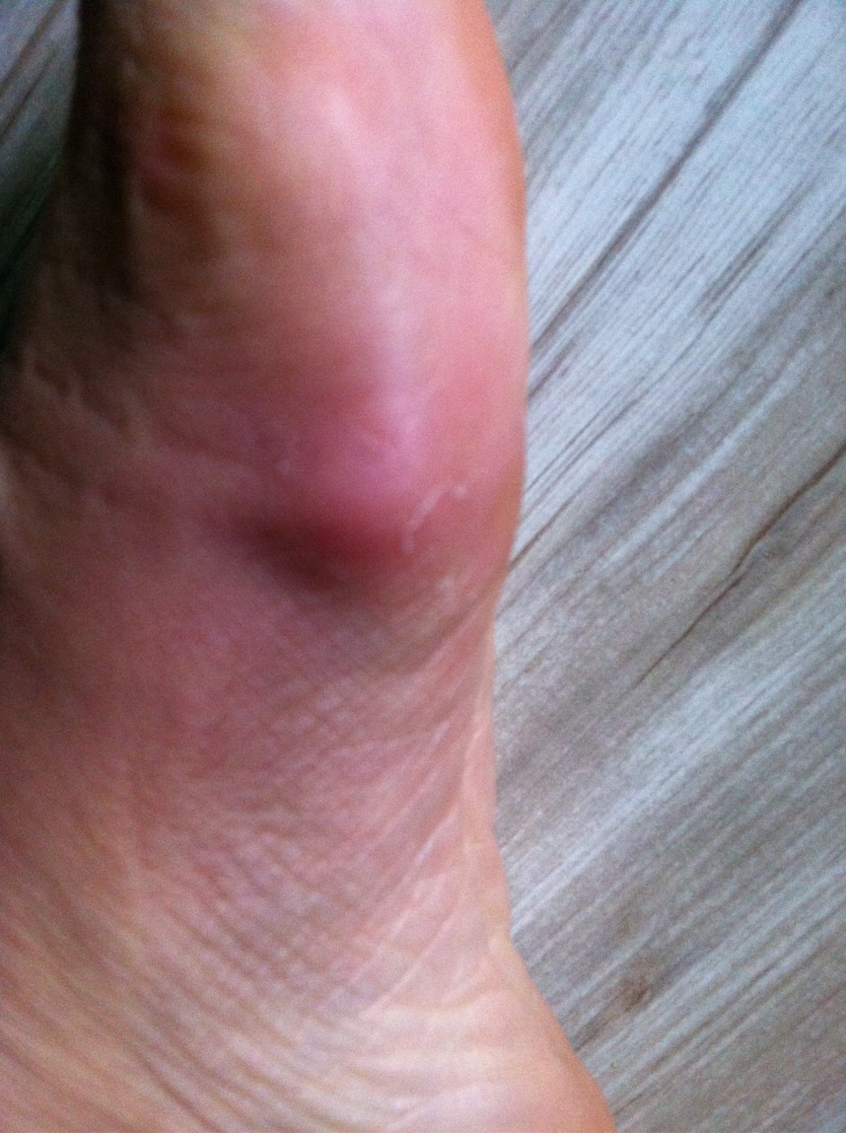 您好,我的脚被钉子扎了,一个月了,封口了,但是里面感觉有脓