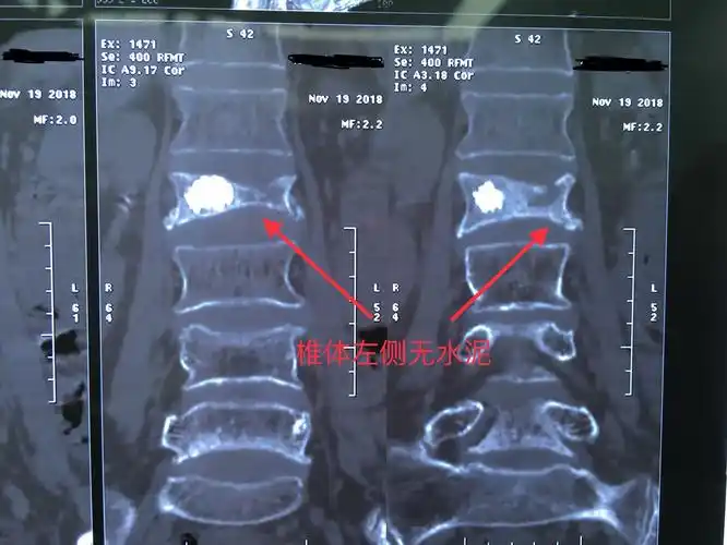 微创手术系列四.《椎体成形技术治疗腰椎椎体陈旧性骨折》