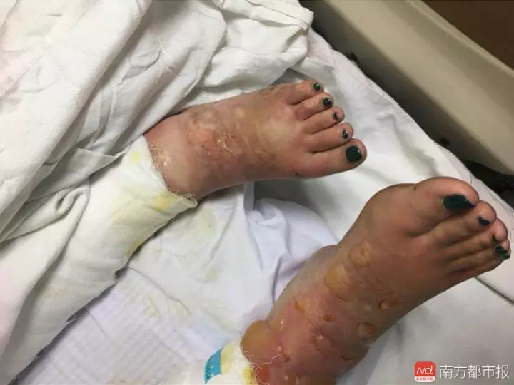 24岁女孩重度烧伤病情危重 母亲探望途中车祸身亡