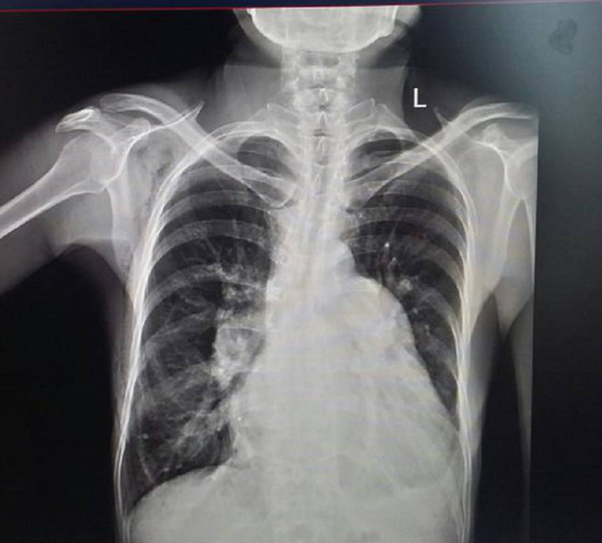 胸片正常为什么也可能查出是肺癌成都肿瘤中医左都华主任