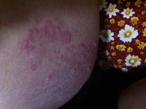 生殖器周围长了很多大片的红块,稍微凸起