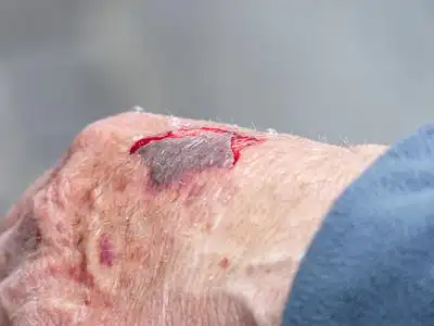 伤口修复皮肤图片_伤口修复皮肤素材_伤口修复皮肤高清图片_摄图网