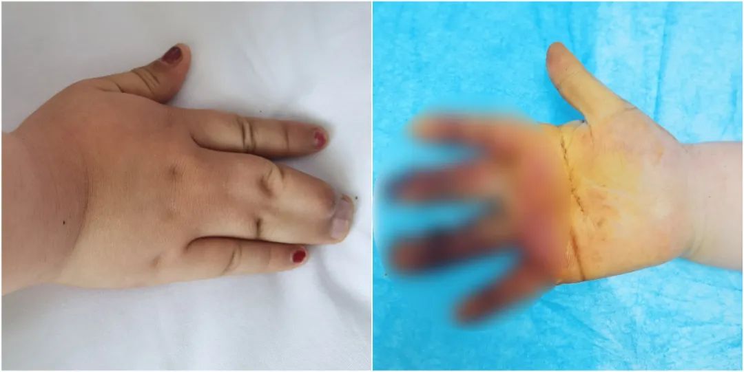 妙手重建指蹼 并指姑娘在烟台山医院开心比"耶"