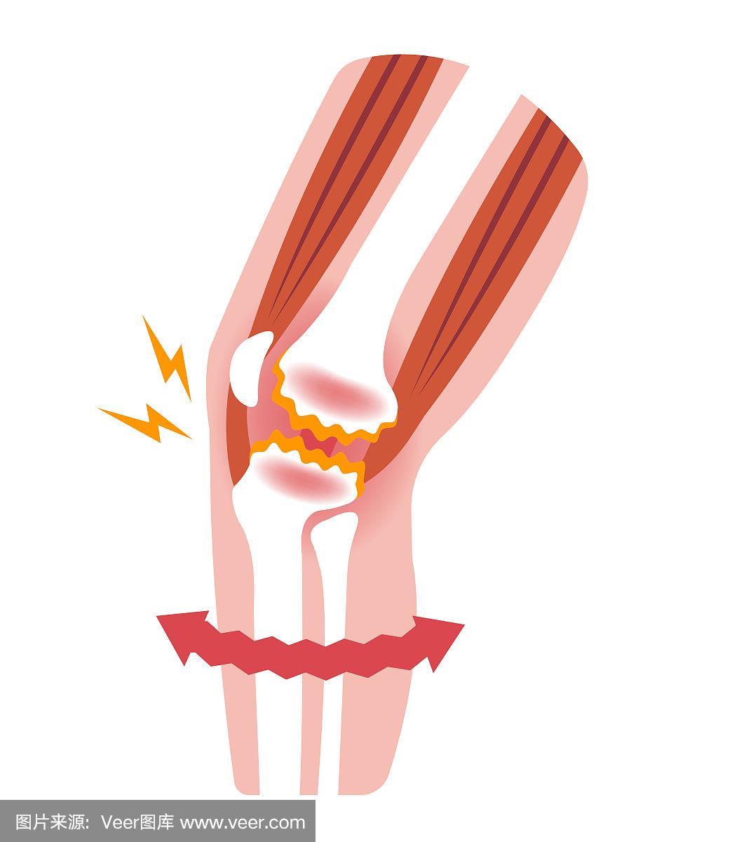 绘画插图,痛苦,膝,骨关节炎,空白的