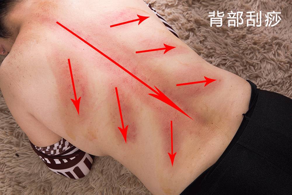 待丰富出痧形成深红色斑条即可不得来回刮动,每条大概刮20下刮痧时
