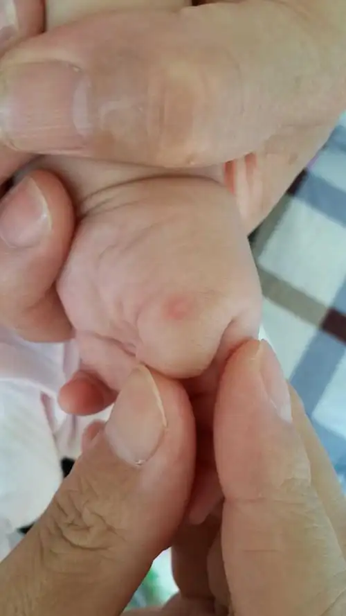 宝宝四个多月,手上长了一个疱疹,求助有什么好办法可以治?