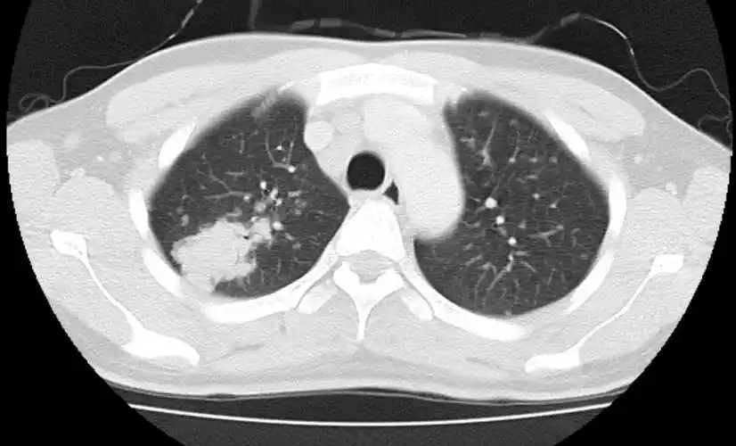 多发小结节状卫星灶的肺结核