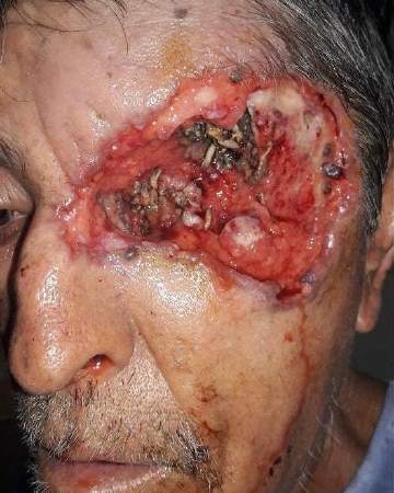 虫子怎么会进眼睛 蝇蛆病是一种让人望. 来自医僧君 - 微博