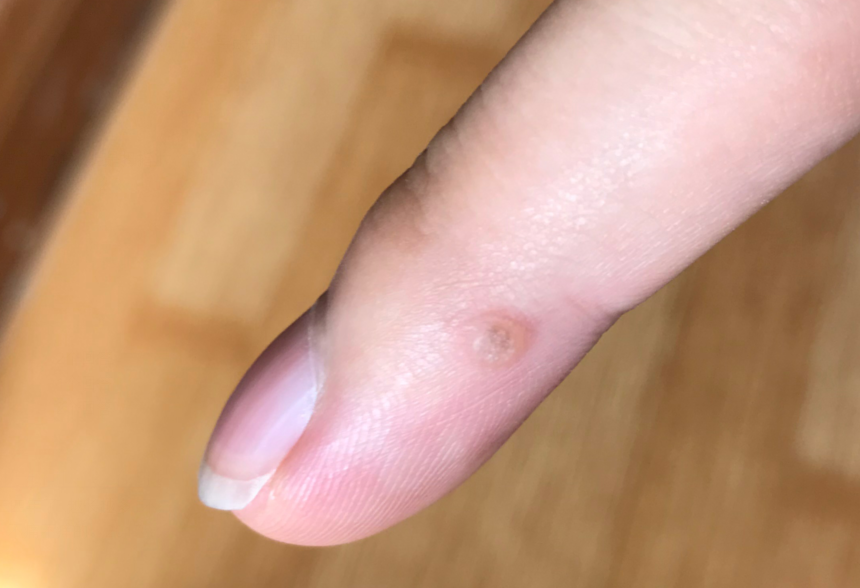 手指上突起了一个肉