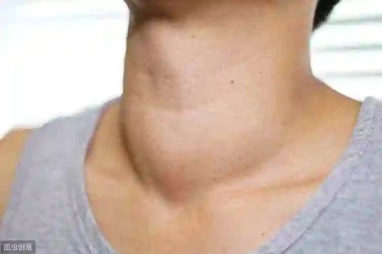 甲状腺有什么症状如何自测甲状腺是否正常